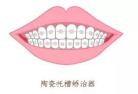 當 整牙 成為一種潮流,矯牙前最該考慮這4個問題