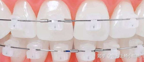 上海學生黨矯正牙齒去哪里既實惠又靠譜 學生黨,23歲,矯正牙齒愿望強烈